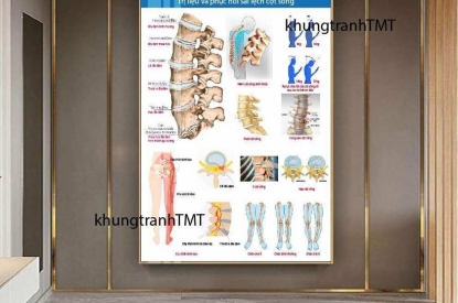 SƠ ĐỒ CÁC BỆNH LÝ XƯƠNG KHỚP THƯỜNG GẶP-GIÚP KHẮC PHỤC TÌNH TRẠNG SAI LỆCH CỘT SỐNG