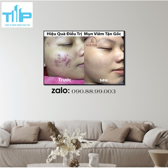 Tranh chăm sóc da điều trị bằng laser